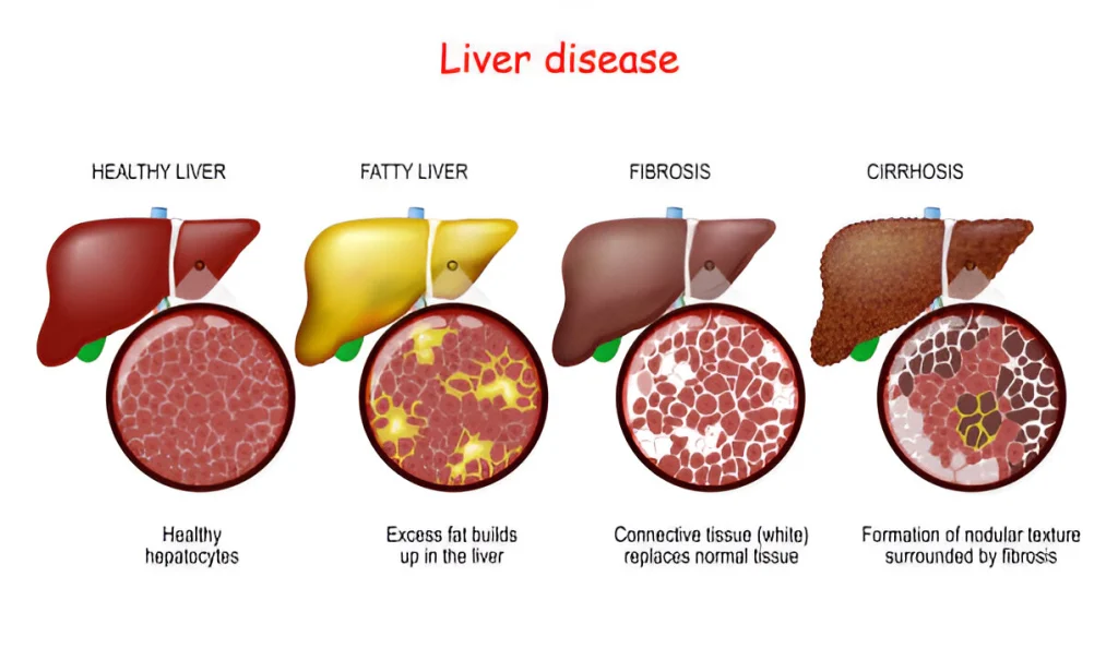 Fatty Liver symptoms