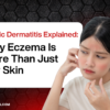 Atopic Dermatitis Explained: Why Eczema Is More Than Just Dry Skin