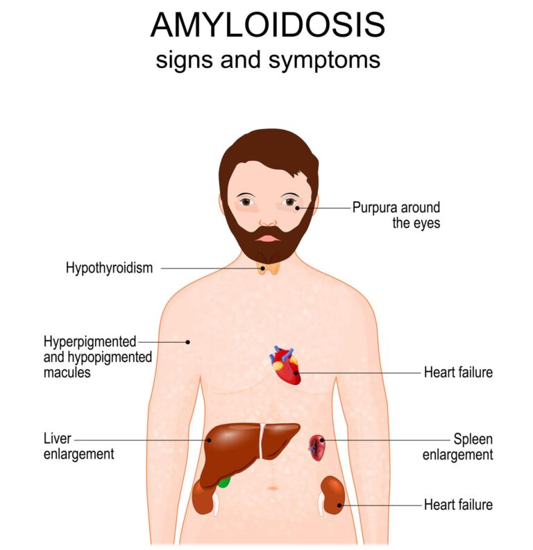 Understanding the Different Types of Amyloidosis (AL, AA, Hereditary & ATTR)
