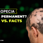 Is Alopecia Areata Permanent? Myths vs. Facts