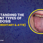 Understanding the Different Types of Amyloidosis (AL, AA, Hereditary & ATTR)