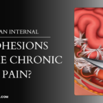 Can Internal Adhesions Cause Chronic Pain?
