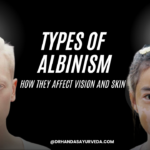 Types of Albinism and How They Affect Vision and Skin